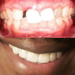 Savannah Smile Designs veneers result — Savannah, GA