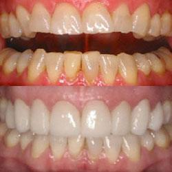 Savannah Smile Designs veneers result — Savannah, GA