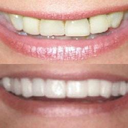Savannah Smile Designs veneers result — Savannah, GA