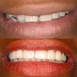 Savannah Smile Designs veneers result — Savannah, GA