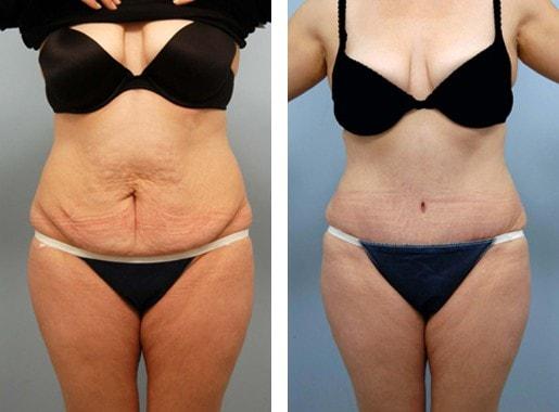 Lawrence M. Koplin, MD tummy tuck result — Beverly Hills, CA