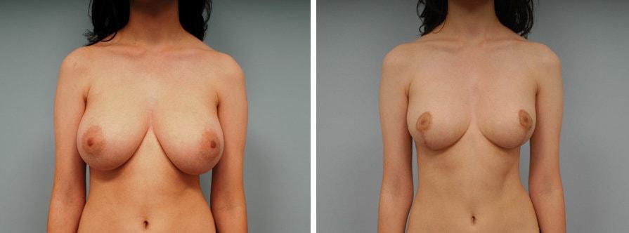 Lawrence M. Koplin, MD breast reduction result — Beverly Hills, CA