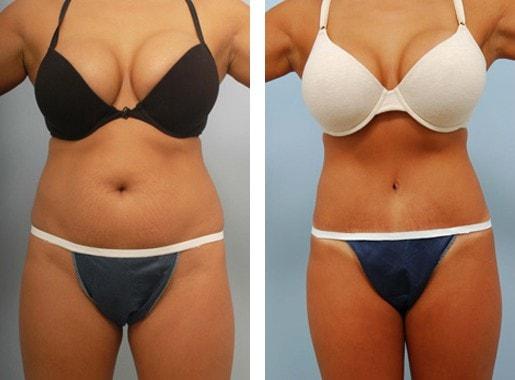 Lawrence M. Koplin, MD tummy tuck result — Beverly Hills, CA
