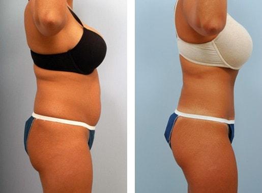 Lawrence M. Koplin, MD tummy tuck result — Beverly Hills, CA