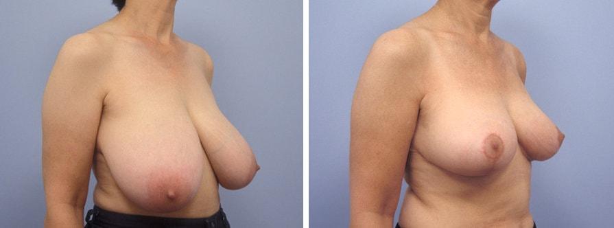 Lawrence M. Koplin, MD breast reduction result — Beverly Hills, CA