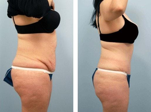 Lawrence M. Koplin, MD tummy tuck result — Beverly Hills, CA