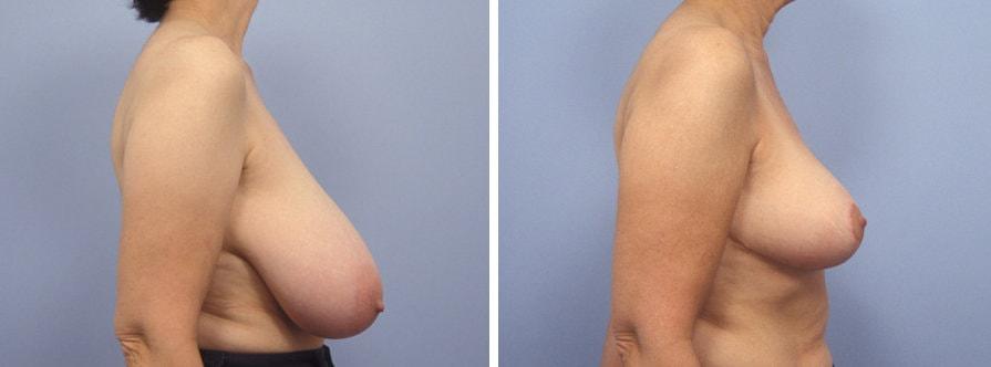 Lawrence M. Koplin, MD breast reduction result — Beverly Hills, CA