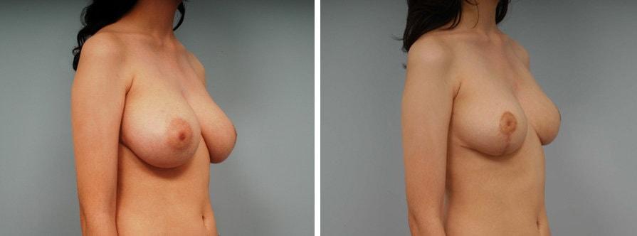 Lawrence M. Koplin, MD breast reduction result — Beverly Hills, CA