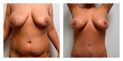 Mommy Makeover result at Smith Plastic Surgery in Las Vegas, NV