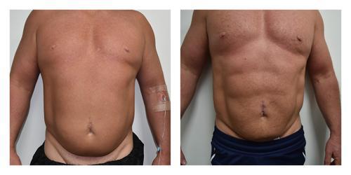 Liposuction result at Smith Plastic Surgery in Las Vegas, NV