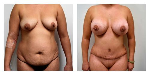 Mommy Makeover result at Smith Plastic Surgery in Las Vegas, NV