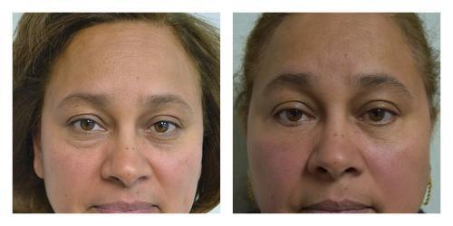 Blepharoplasty result at Smith Plastic Surgery in Las Vegas, NV