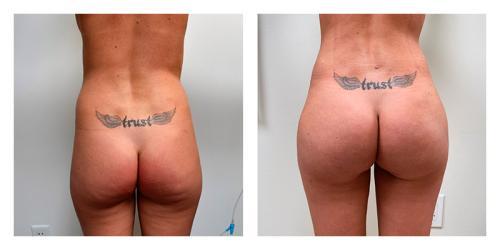 Brazilian Butt Lift result at Smith Plastic Surgery in Las Vegas, NV