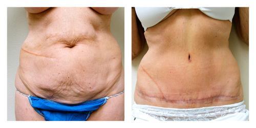 Tummy Tuck result at Smith Plastic Surgery in Las Vegas, NV
