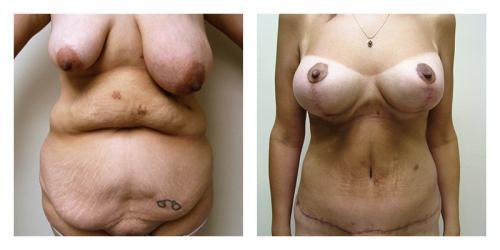 CoolSculpting result at Smith Plastic Surgery in Las Vegas, NV