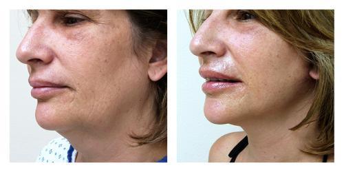 Neck Lift result at Smith Plastic Surgery in Las Vegas, NV