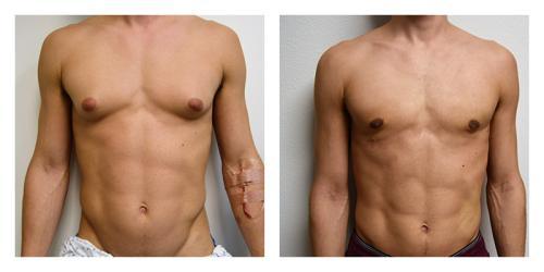 Gynecomastia Surgery result at Smith Plastic Surgery in Las Vegas, NV
