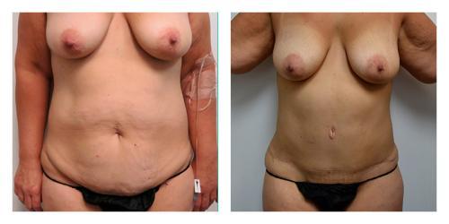 Smith Plastic Surgery tummy tuck result — Las Vegas, NV