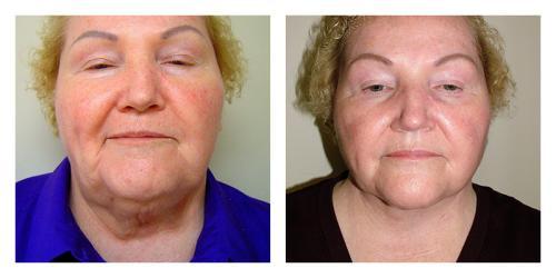 Neck Lift result at Smith Plastic Surgery in Las Vegas, NV