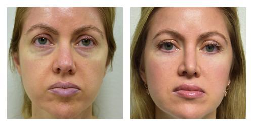 Fat Transfer result at Smith Plastic Surgery in Las Vegas, NV