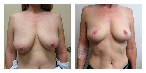Breast Lift result at Smith Plastic Surgery in Las Vegas, NV