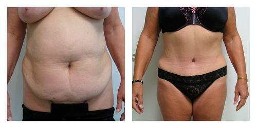 Smith Plastic Surgery tummy tuck result — Las Vegas, NV