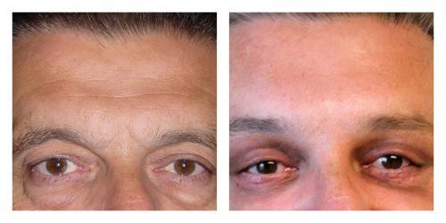 Brow Lift result at Smith Plastic Surgery in Las Vegas, NV