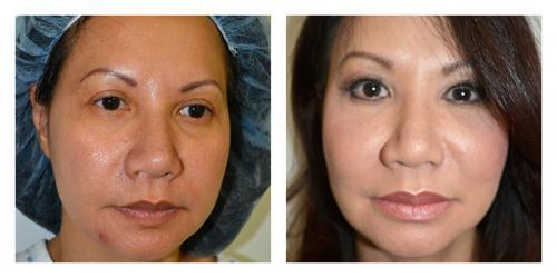 Fat Transfer result at Smith Plastic Surgery in Las Vegas, NV