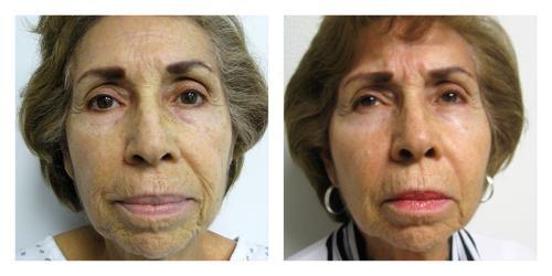 Fat Transfer result at Smith Plastic Surgery in Las Vegas, NV