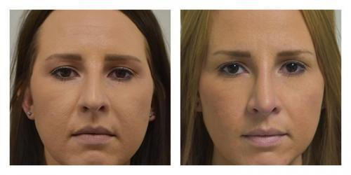 Rhinoplasty result at Smith Plastic Surgery in Las Vegas, NV