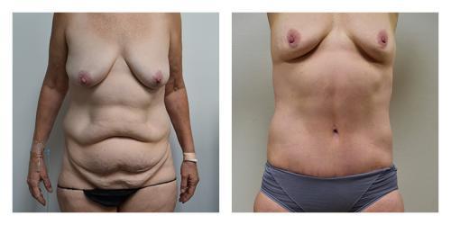 CoolSculpting result at Smith Plastic Surgery in Las Vegas, NV