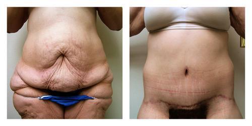 CoolSculpting result at Smith Plastic Surgery in Las Vegas, NV