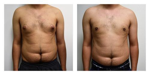 Gynecomastia Surgery result at Smith Plastic Surgery in Las Vegas, NV