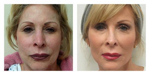 Fat Transfer result at Smith Plastic Surgery in Las Vegas, NV