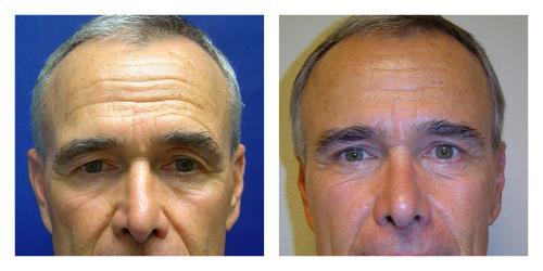 Brow Lift result at Smith Plastic Surgery in Las Vegas, NV