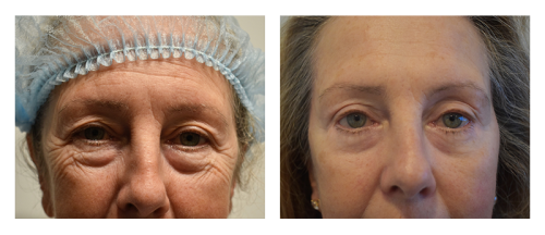 Brow Lift result at Smith Plastic Surgery in Las Vegas, NV