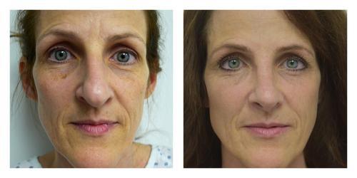 Fat Transfer result at Smith Plastic Surgery in Las Vegas, NV