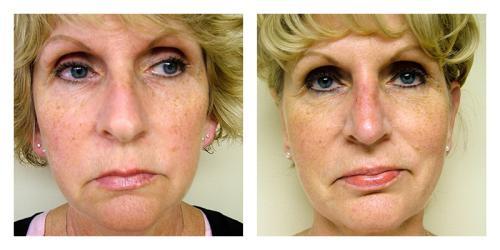 Neck Lift result at Smith Plastic Surgery in Las Vegas, NV