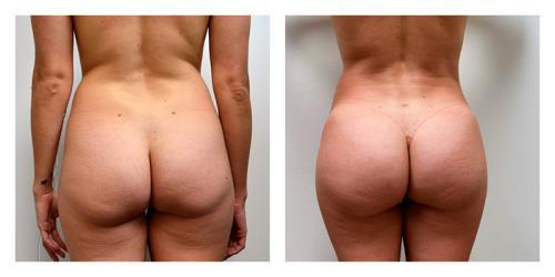 Brazilian Butt Lift result at Smith Plastic Surgery in Las Vegas, NV