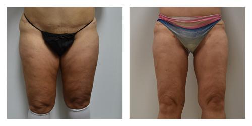 CoolSculpting result at Smith Plastic Surgery in Las Vegas, NV