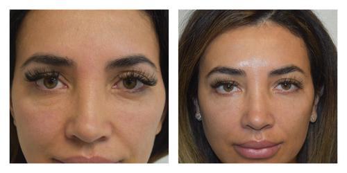 Fat Transfer result at Smith Plastic Surgery in Las Vegas, NV