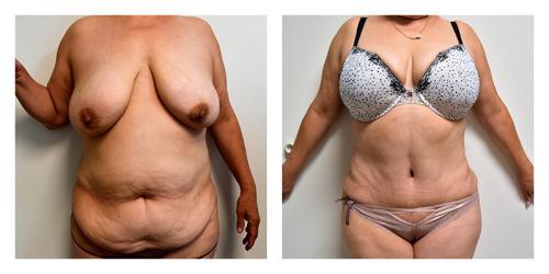 Smith Plastic Surgery tummy tuck result — Las Vegas, NV