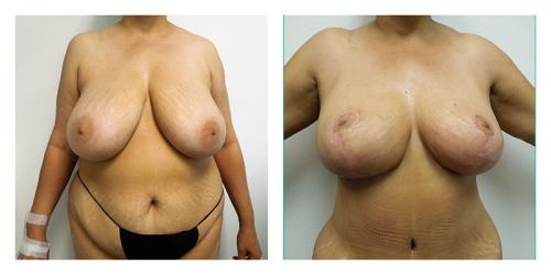 Breast Lift result at Smith Plastic Surgery in Las Vegas, NV