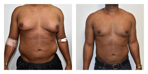 Gynecomastia Surgery result at Smith Plastic Surgery in Las Vegas, NV