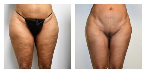 CoolSculpting result at Smith Plastic Surgery in Las Vegas, NV