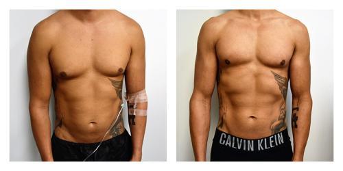 Gynecomastia Surgery result at Smith Plastic Surgery in Las Vegas, NV
