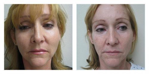 Facelift result at Smith Plastic Surgery in Las Vegas, NV