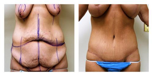 CoolSculpting result at Smith Plastic Surgery in Las Vegas, NV
