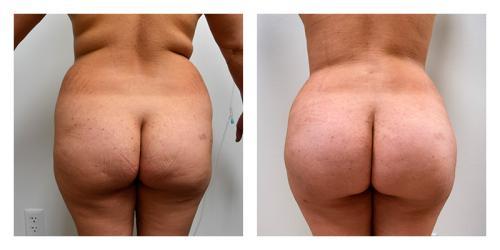 Brazilian Butt Lift result at Smith Plastic Surgery in Las Vegas, NV