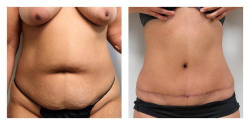 Smith Plastic Surgery tummy tuck result — Las Vegas, NV